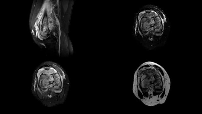右膝关节MRI病史: 1例15岁女性右股骨病理性骨折。