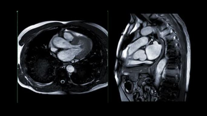 MRI心脏或心脏MRI (磁共振成像) 显示心脏跳动以检测心脏病。