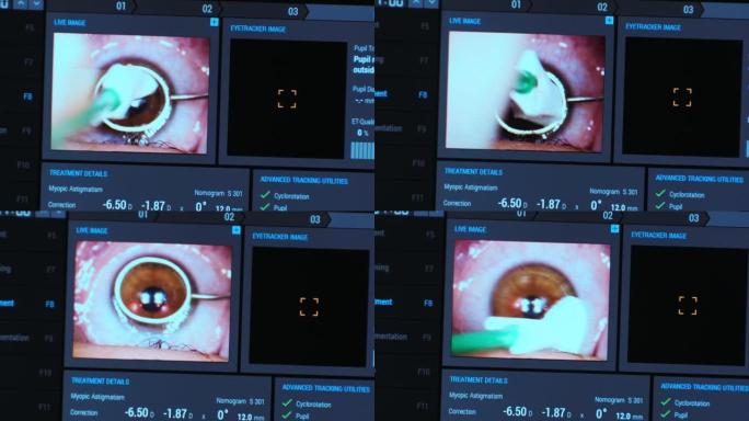 眼科手术。在手术室医疗监护仪的屏幕上查看。Lasik