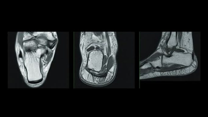 MRI踝关节对足损伤肌腱的诊断价值。