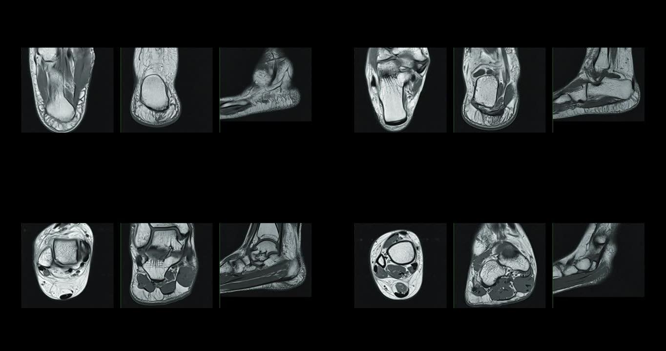 MRI踝关节对足损伤肌腱的诊断价值。