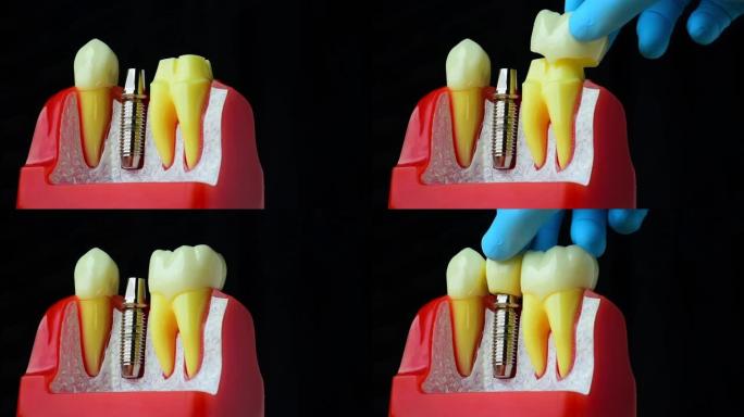 牙种植体模型。