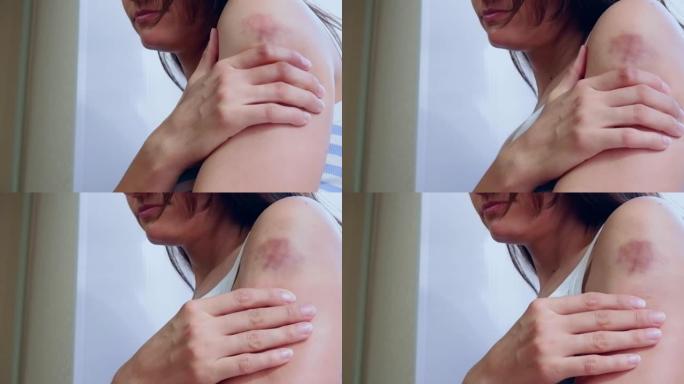 一名身穿白色和蓝色t恤的妇女，手臂上有瘀伤，坐在窗边特写镜头时用手触摸伤口。