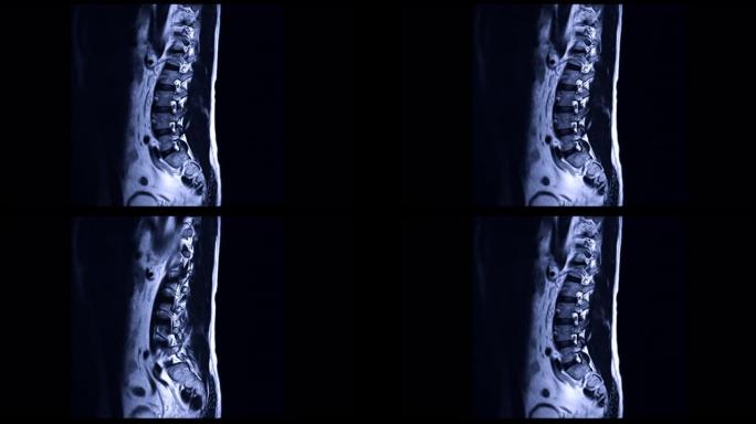 MRI在矢状面上的l-s脊柱或腰椎诊断脊髓压迫。