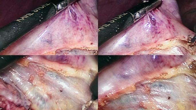 腹腔镜手术时腹腔内。