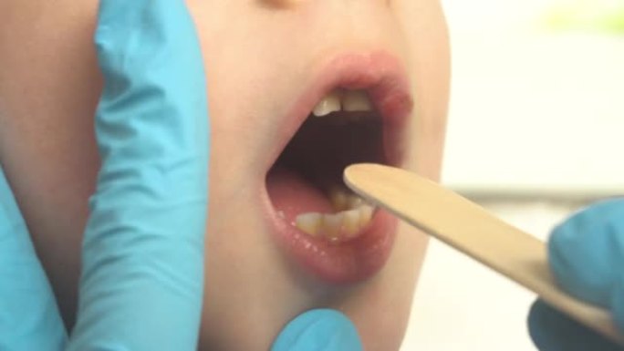 医生使用压舌板检查孩子的嘴和喉咙的特写镜头。耳鼻喉科药物4k