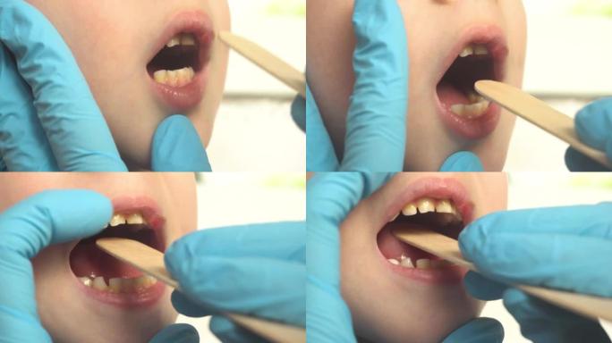 医生使用压舌板检查孩子的嘴和喉咙的特写镜头。耳鼻喉科药物4k