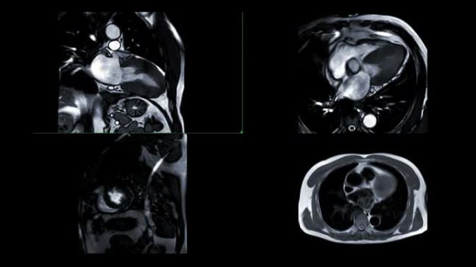 MRI心脏或心脏MRI (磁共振成像) 显示心脏跳动以检测心脏病。