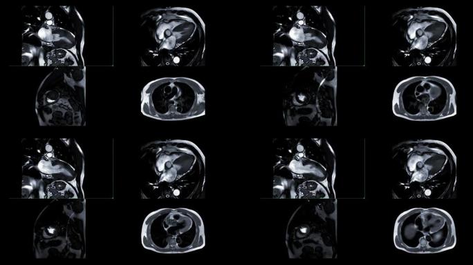 MRI心脏或心脏MRI (磁共振成像) 显示心脏跳动以检测心脏病。