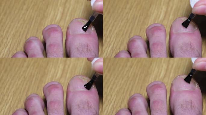 在指甲上涂抹愈合油，以加强指甲板和老化指甲真菌。