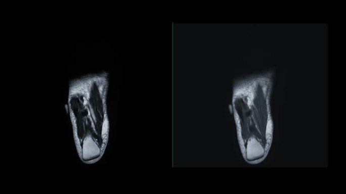 MRI足部冠状视图用于诊断足部损伤的肌腱。