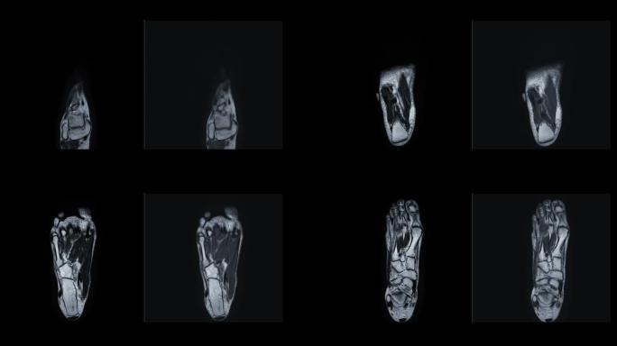MRI足部冠状视图用于诊断足部损伤的肌腱。