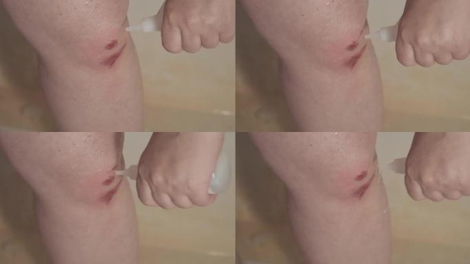 女人清洗和消毒受伤的膝盖