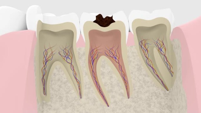 龋齿进展横截面的3D渲染