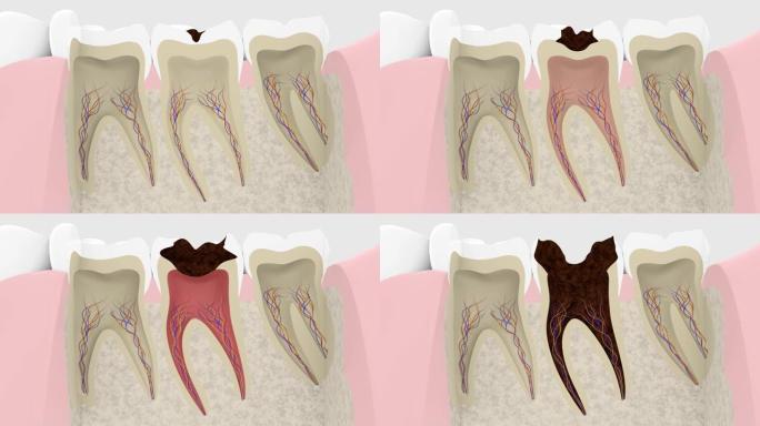 龋齿进展横截面的3D渲染