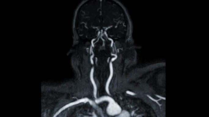 对比MRA脑或磁共振血管造影的脑冠状MIP视图显示脑动脉和颈总动脉。