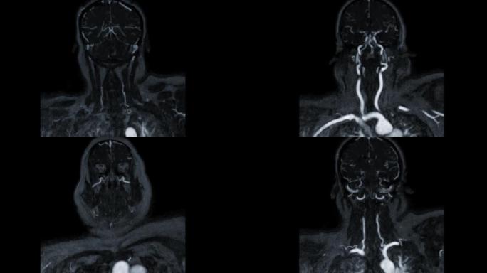 对比MRA脑或磁共振血管造影的脑冠状MIP视图显示脑动脉和颈总动脉。