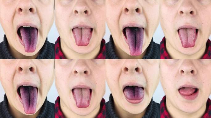 前后。一个男人黑色舌头的特写。绒毛舌的临床表现。口腔细菌感染。服用强抗生素的后果。真菌感染