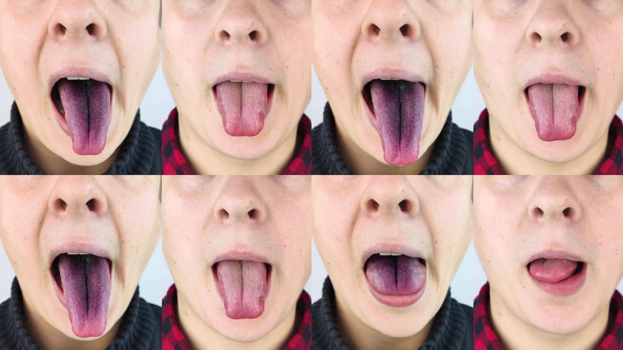 前后。一个男人黑色舌头的特写。绒毛舌的临床表现。口腔细菌感染。服用强抗生素的后果。真菌感染