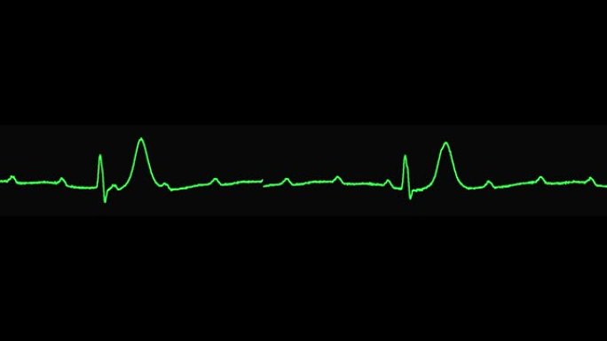 心电图显示完全性房室传导阻滞心律失常