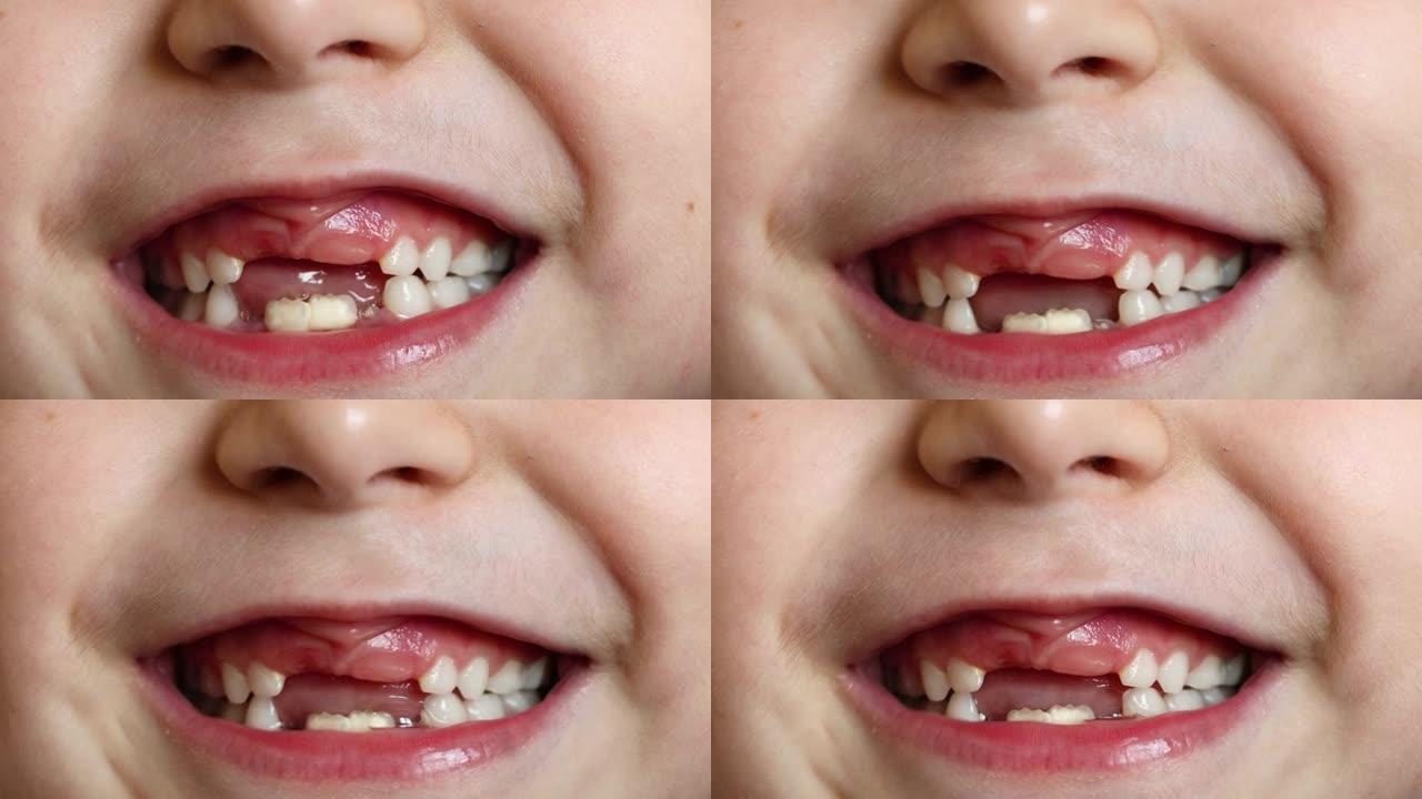 一个6-7岁女孩的特写镜头，牙齿刚萌出。乳牙脱落。新出牙