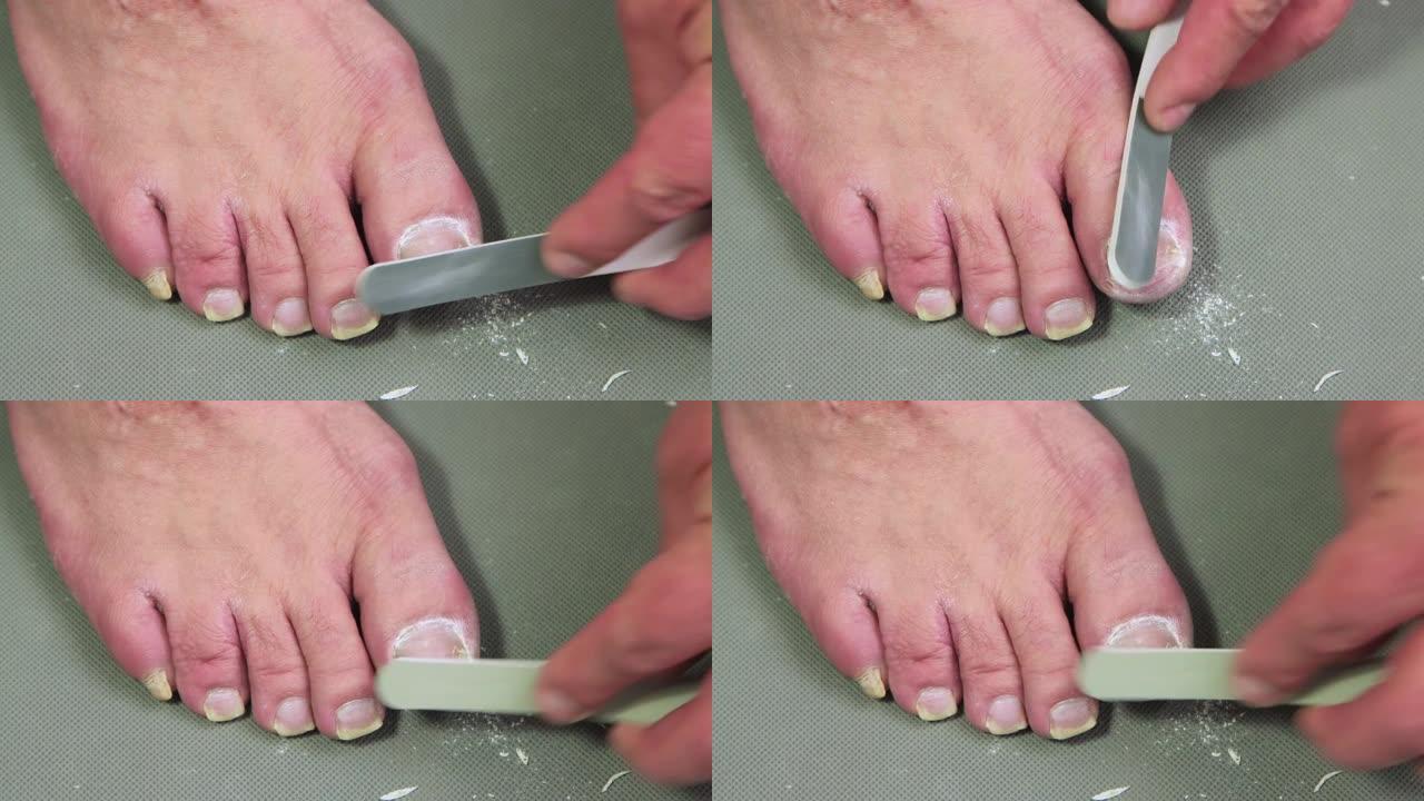 一个拿着灰色塑料文件的人的手在脚上磨了一个大钉子。