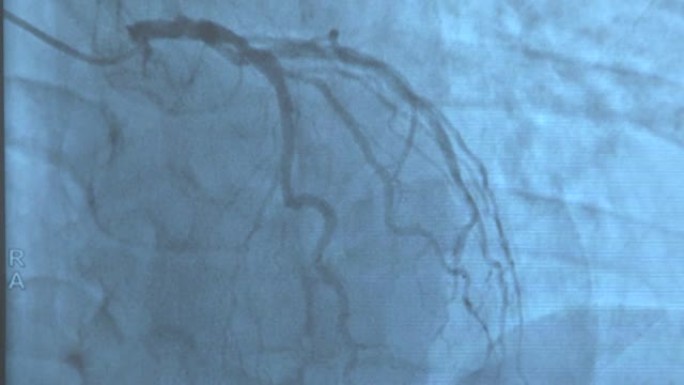 心脏导管插入过程中的冠状动脉。