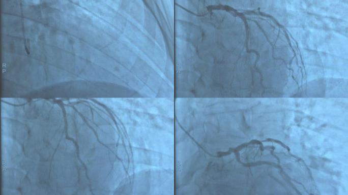 心脏导管插入过程中的冠状动脉。