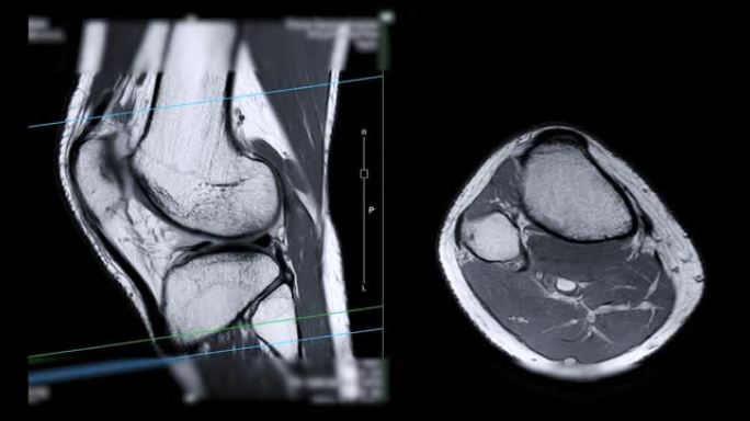 膝关节MRI或磁共振成像。