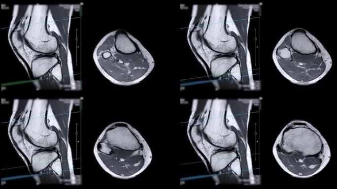 膝关节MRI或磁共振成像。
