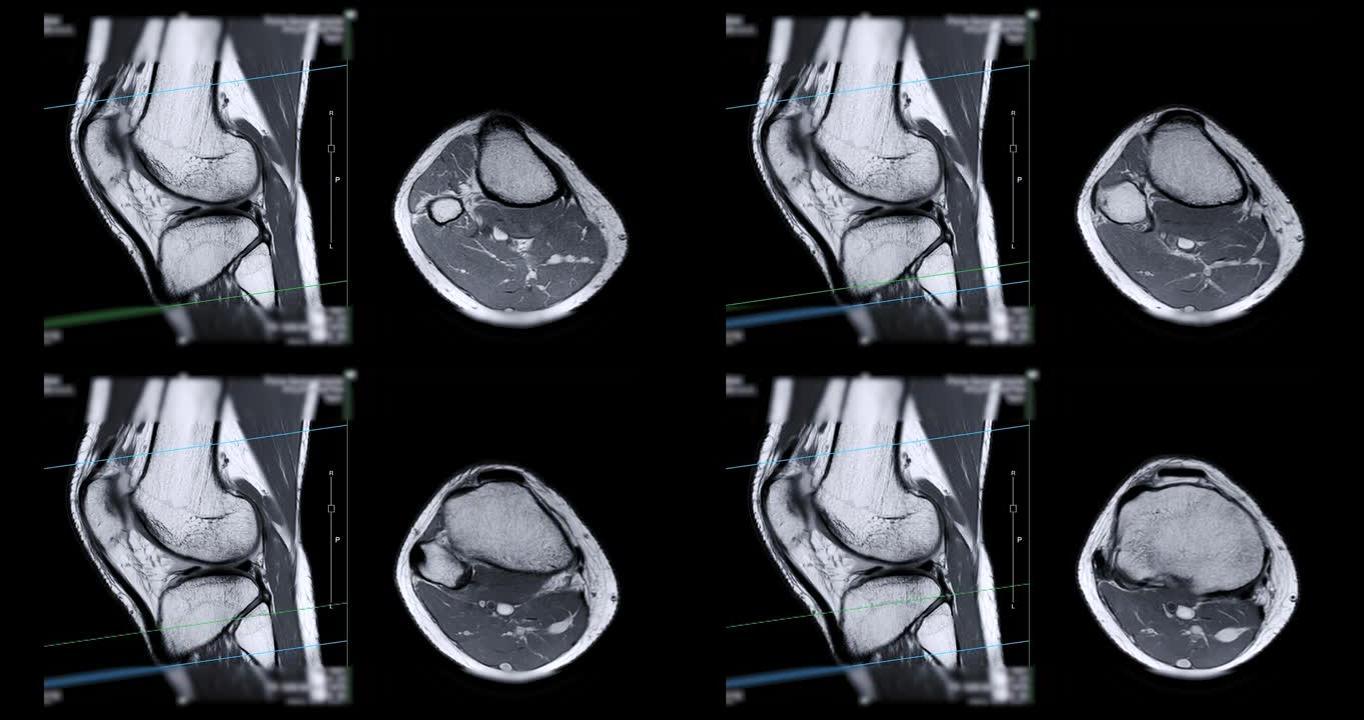 膝关节MRI或磁共振成像。