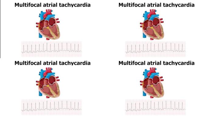 心电图显示心律失常多灶性房性心动过速 (MAT) 伴心脏动画
