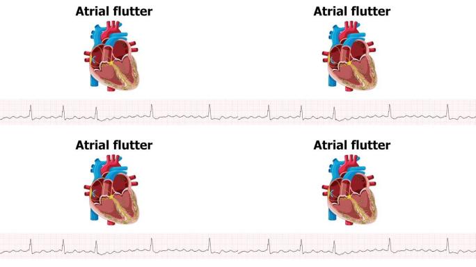 心电图显示心律失常心房扑动伴心脏动画