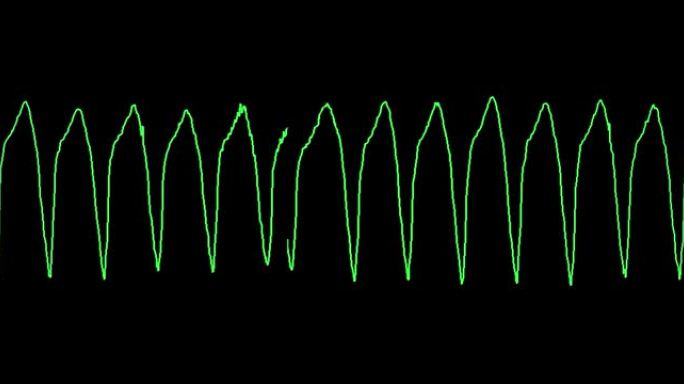 心电图显示室性心动过速 (VT)