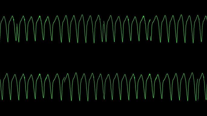 心电图显示室性心动过速 (VT)