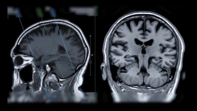 脑MRI比较矢状面和冠状面对痴呆患者海马的诊断价值。