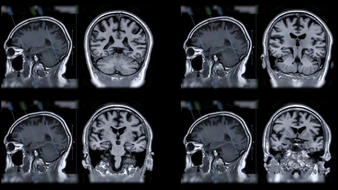 脑MRI比较矢状面和冠状面对痴呆患者海马的诊断价值。