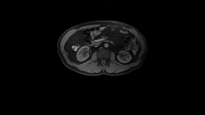 腹部ct扫描。胃肠道，肝脏和肾脏的计算机断层扫描。