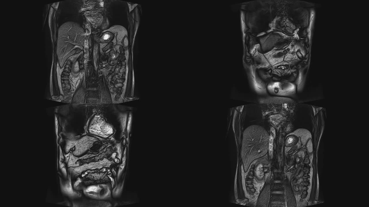 腹部大量ct扫描。胃肠道，肝脏和肾脏的计算机断层扫描