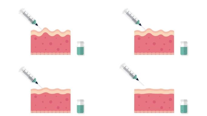 带有皱纹和细纹动画的皮肤注射注射器