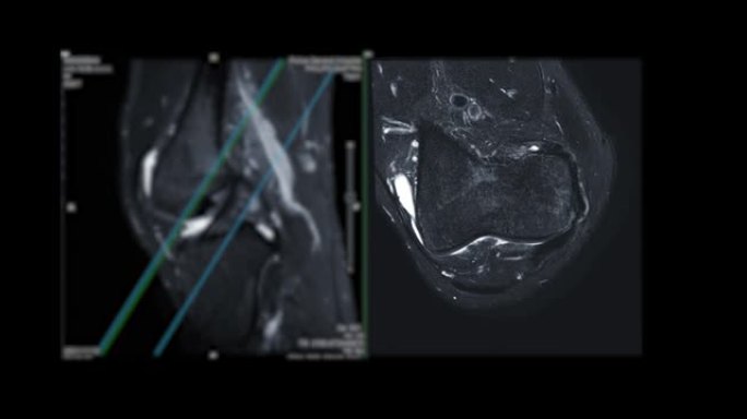 膝关节MRI或磁共振成像。