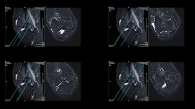 膝关节MRI或磁共振成像。