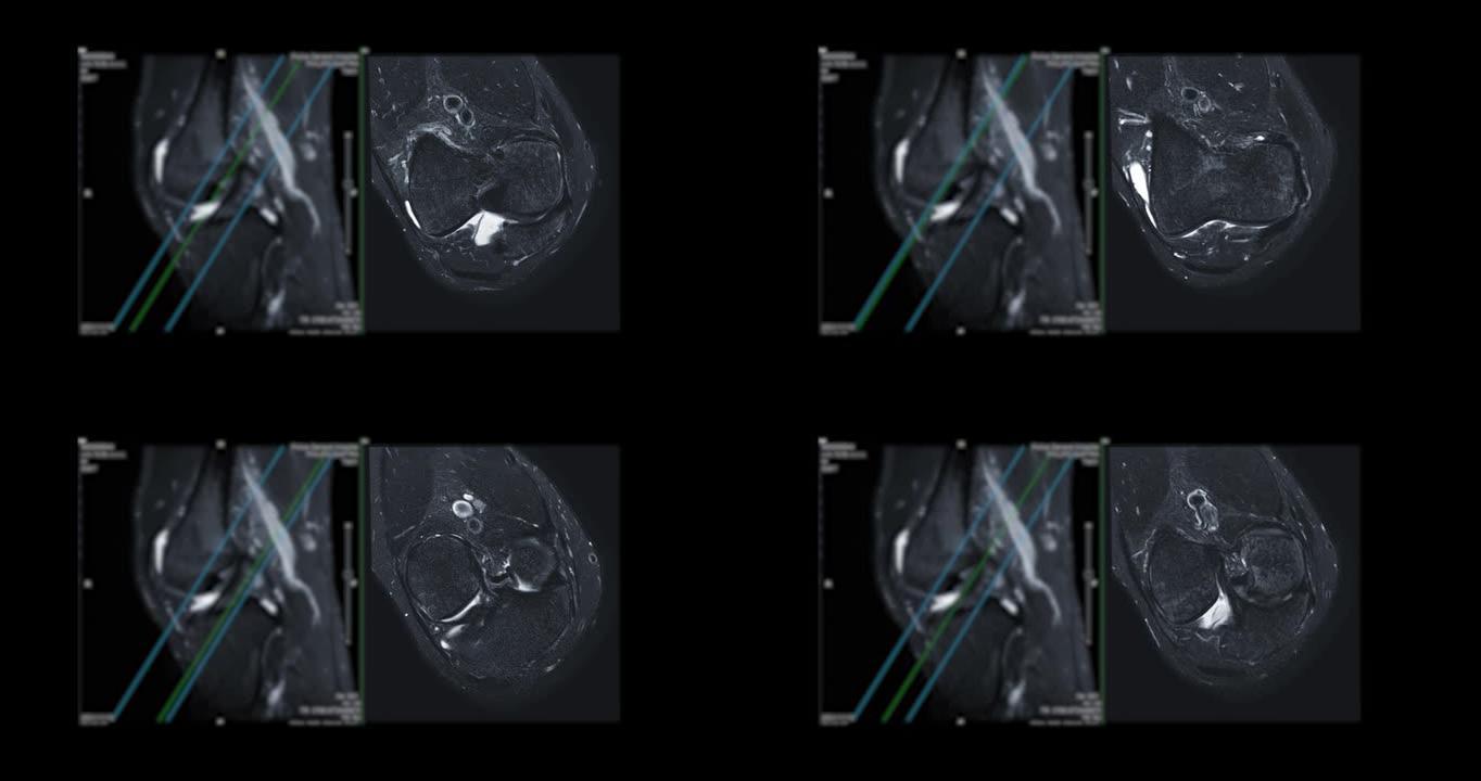 膝关节MRI或磁共振成像。