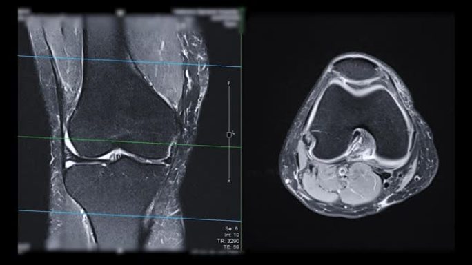 膝关节MRI或磁共振成像。