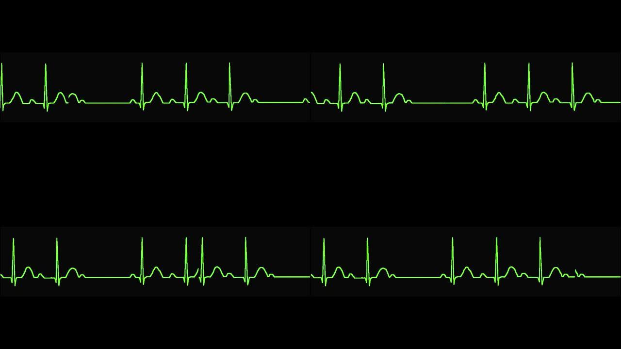 心电图显示2度mobitz 2心律失常