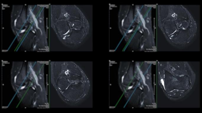 膝关节MRI或磁共振成像。