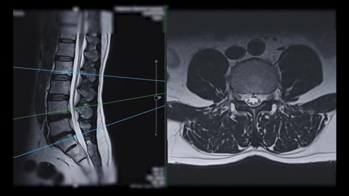 MRI l-s脊柱或腰椎轴向T2W视矢状面诊断脊髓压迫。