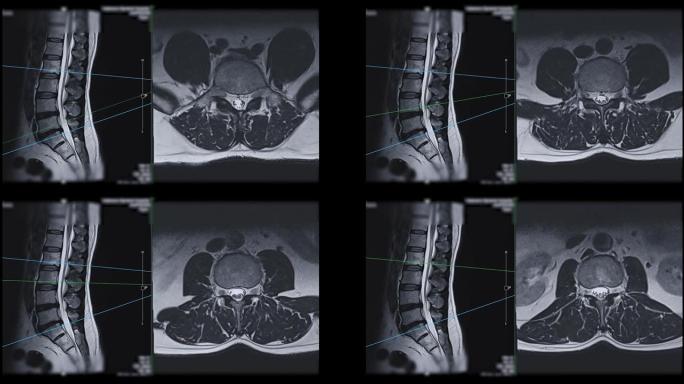 MRI l-s脊柱或腰椎轴向T2W视矢状面诊断脊髓压迫。