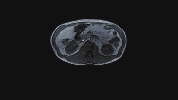 腹部大量彩色ct扫描。胃肠道，肝脏和肾脏的计算机断层扫描