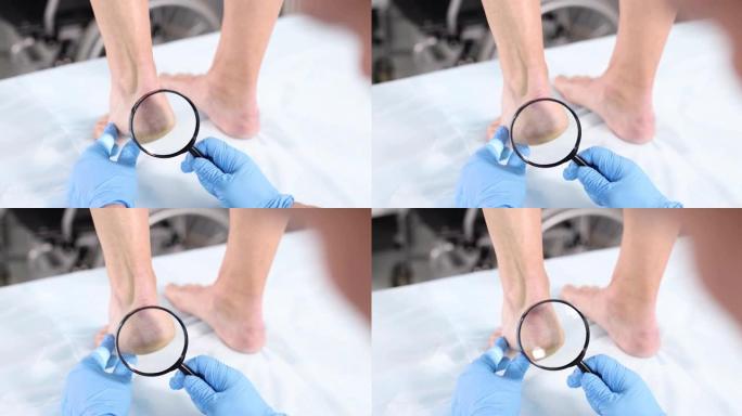 皮肤科医生通过放大镜对腿部皮肤进行体格检查